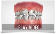 3D Animation showing teeth movements