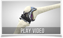 video 3d protesi ginocchio