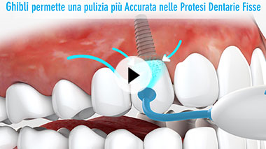 Sistema di pulizia protesi dentale